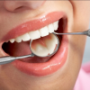 Lấy cao răng là gì? Tại sao phải lấy cao răng định kỳ?