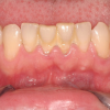 Mảng bám cứng trên răng- “Kẻ khơi nguồn” cho các bệnh về răng miệng