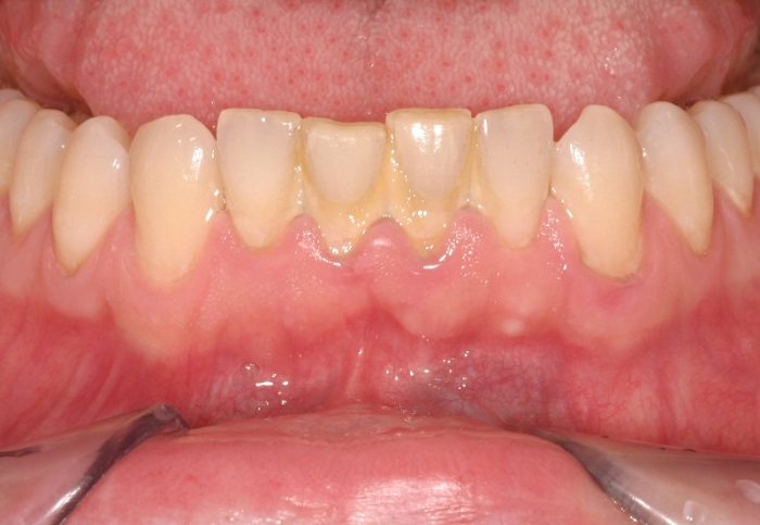 Mảng bám cứng trên răng- “Kẻ khơi nguồn” cho các bệnh về răng miệng